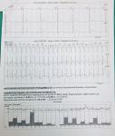 Синдром или феномен WPW? фото 3