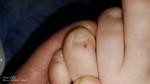Пятно не понятного происхождения на пальце ноги фото 2