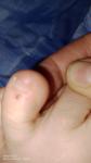 Пятно не понятного происхождения на пальце ноги фото 3