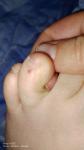 Пятно не понятного происхождения на пальце ноги фото 4