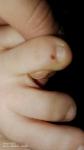 Пятно не понятного происхождения на пальце ноги фото 5