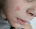 Красная сыпь на лице у ребенка фото 1