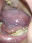 Болячка сбоку языка, болит фото 2