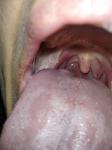 Болячка сбоку языка, болит фото 1