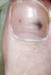 Черное пятно на ногте, что это? фото 1
