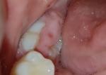 Жевательный зуб фото 1