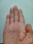 Сухость кожи пальцев рук с растрескиванием фото 1