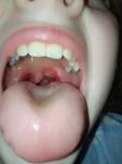 Воспаление и налет в горле с гнойниками фото 1