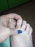 Раздражение на пальце ноги фото 4