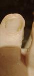 Отслойка ногтя у бокового валика фото 1