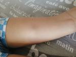 Воспалилась вена на ноге у ребенка 6 лет фото 1