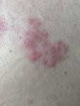 Воспаление лимфоузла и высыпания на коже фото 2
