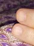 Проблема с ногтями на рукахабет, многоузловой зоб, хронический гастрит фото 2