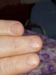 Проблема с ногтями на рукахабет, многоузловой зоб, хронический гастрит фото 1