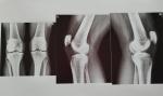 Рентген колен. Сильные боли фото 1