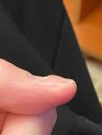 Деформация ногтя у подростка фото 1