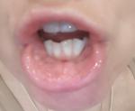 Воспаление слизистой губ и рта фото 1