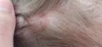 Кольцеобразные высыпания на коже головы фото 2