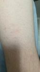Гусиная кожа или атопический дерматит фото 2