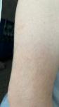 Гусиная кожа или атопический дерматит фото 1