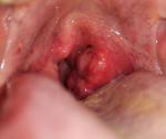 Воспаленные миндалины, черная точка, сильная боль в горле фото 1