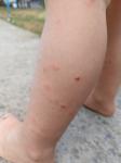 Сыпь у ребёнка, похожая на укусы комаров фото 1