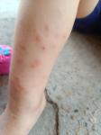 Сыпь у ребёнка, похожая на укусы комаров фото 3