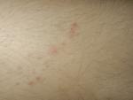 Сыпь на ноге, чешется, с разрастающимися пузырями и красными точками фото 2