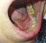 Лейкоплакия дна рта фото 1