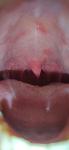 Красные пятна в полости рта(болят) фото 2
