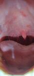 Красные пятна в полости рта(болят) фото 1
