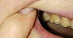 Дырка в зубе после профгигиены фото 1