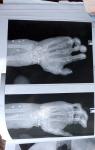 Перелом лучевой кости руки фото 2