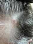 Появился нарост на волосистой части головы фото 3