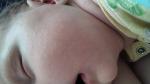 Прищыки на щеках у грудного ребенка фото 1