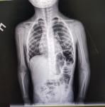 Є пневманія у дитини фото 1