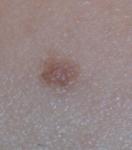 В родинке белые точки фото 2