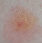 Прыщ и вокруг сильное покраснение фото 1