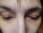 Отёк внутреннего угла верхнего века фото 3