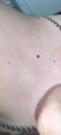 Странная черная родинка фото 3