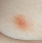 Пятно на внутренней стороне бедра без зуда фото 2