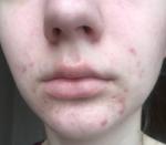 Борюсь с акне уже 5 лет фото 5