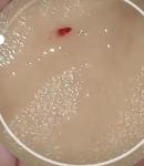 Розовая мокрота с прожилками крови фото 1