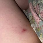 Сыпь не проходит долго фото 2