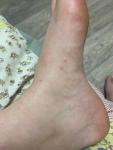 Сыпь не проходит долго фото 4