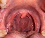 Новообразование в горле, чувство инородного тела фото 1
