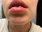 Пузыри на внутренней стороне губы фото 3