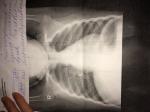 Расшифровка рентгена лёгких фото 1