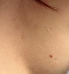 Высыпания(?) белого цвета фото 2