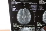 Ночная эпилепсия, головная боль, киста головного мозга фото 2